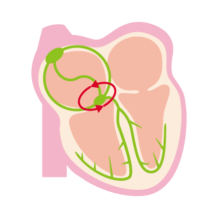 房室結節リエントリー性頻拍