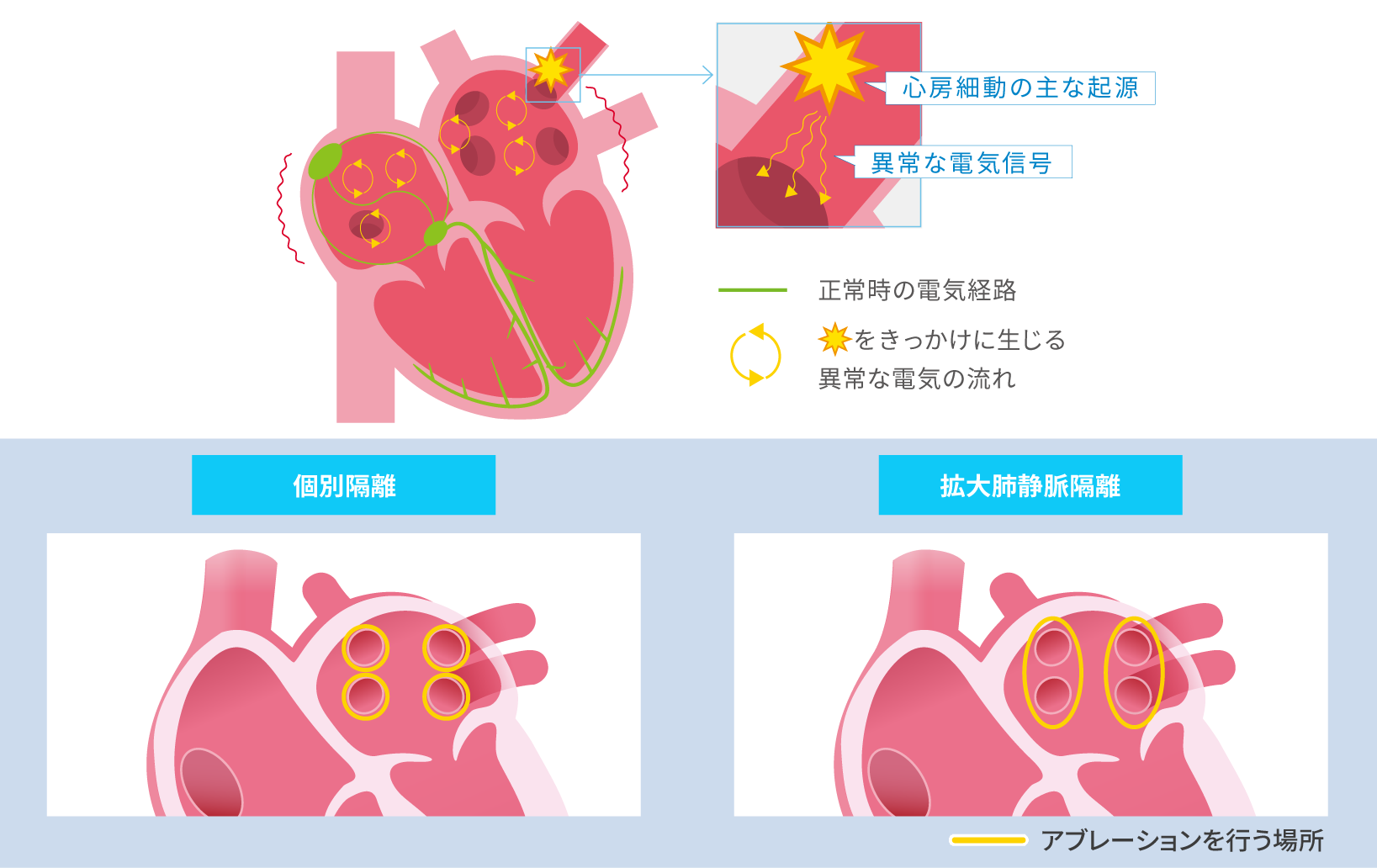 アブレーションを行う場所