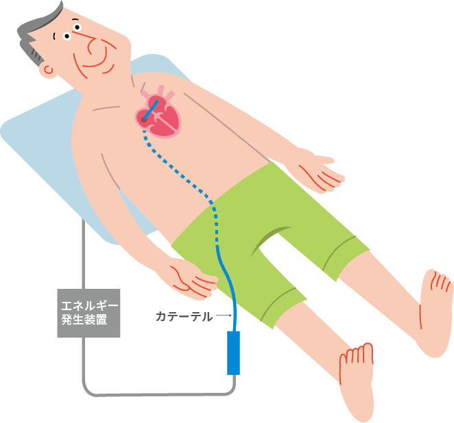カテーテルアブレーションの種類