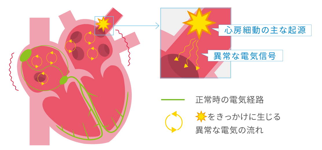 心房細動