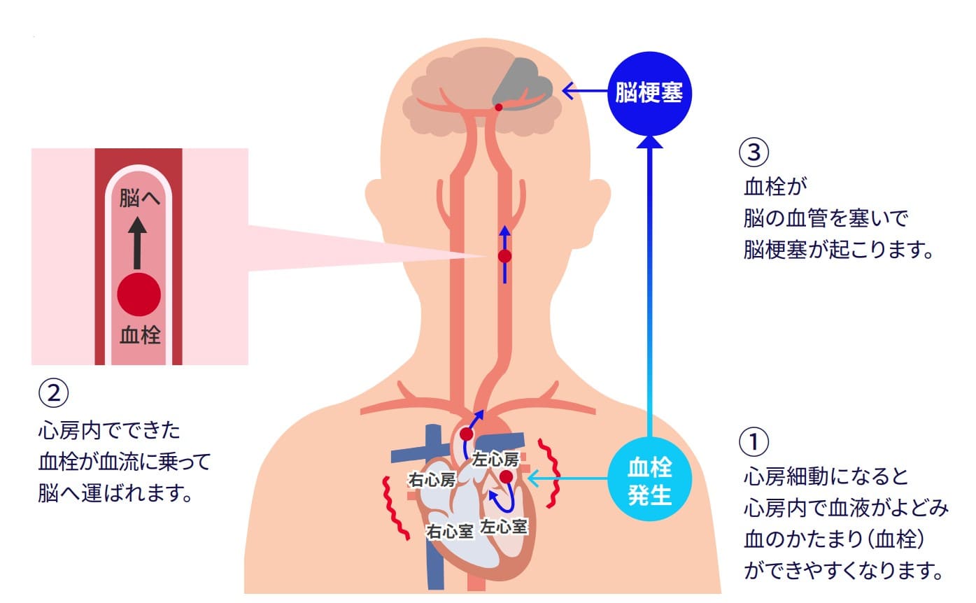 脳梗塞が起こる仕組み