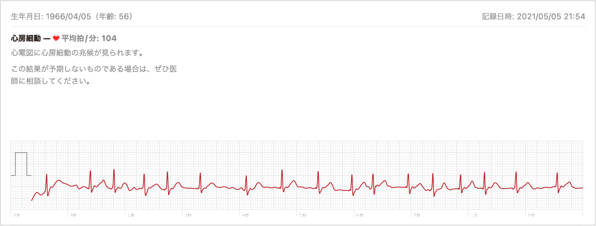 AppleWatchで記録した心電図